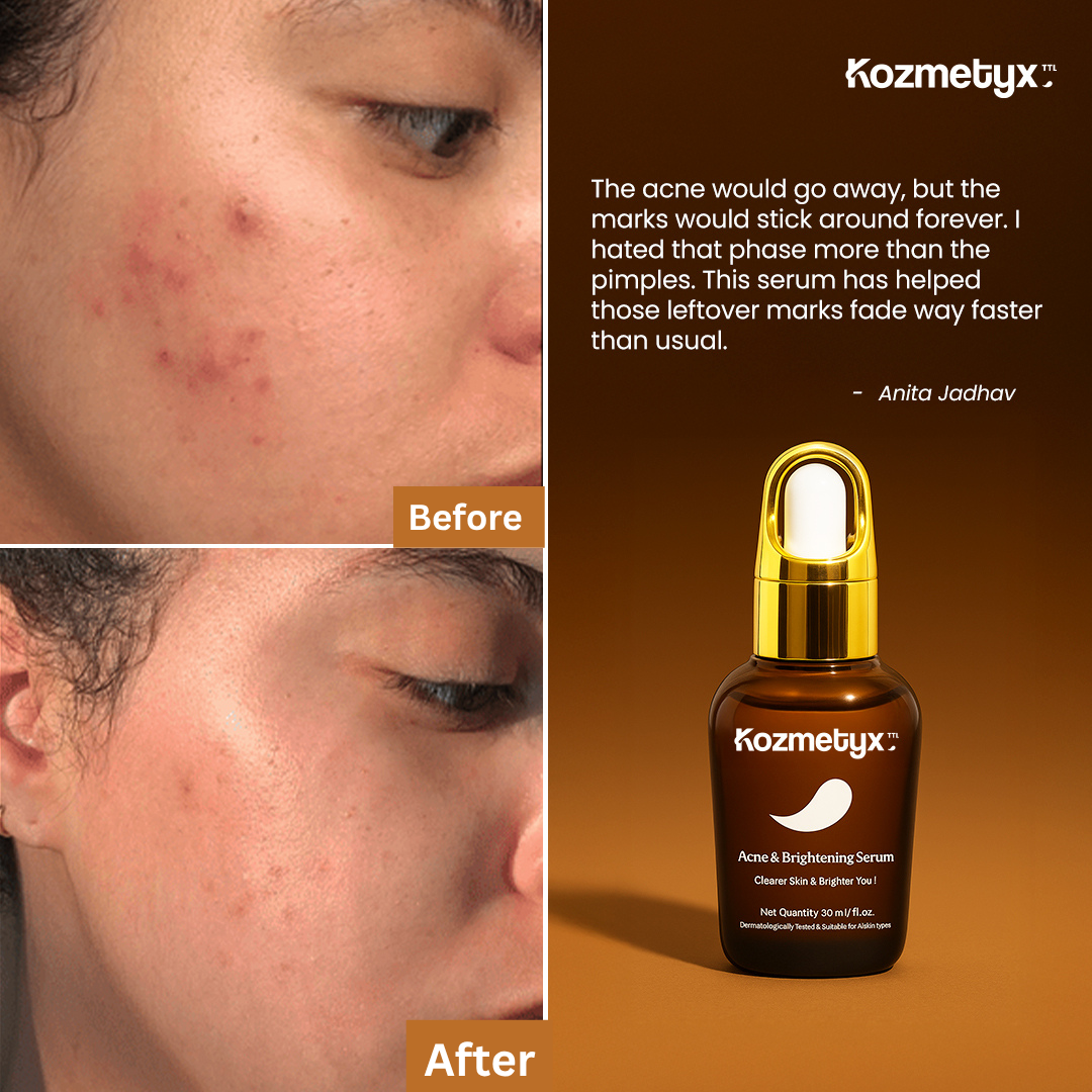 Anti Acne and Brightening Serum - Arbutin + GlowReset - SkinSync-AcneComplex - Dark Spot Corrector - 30 ML