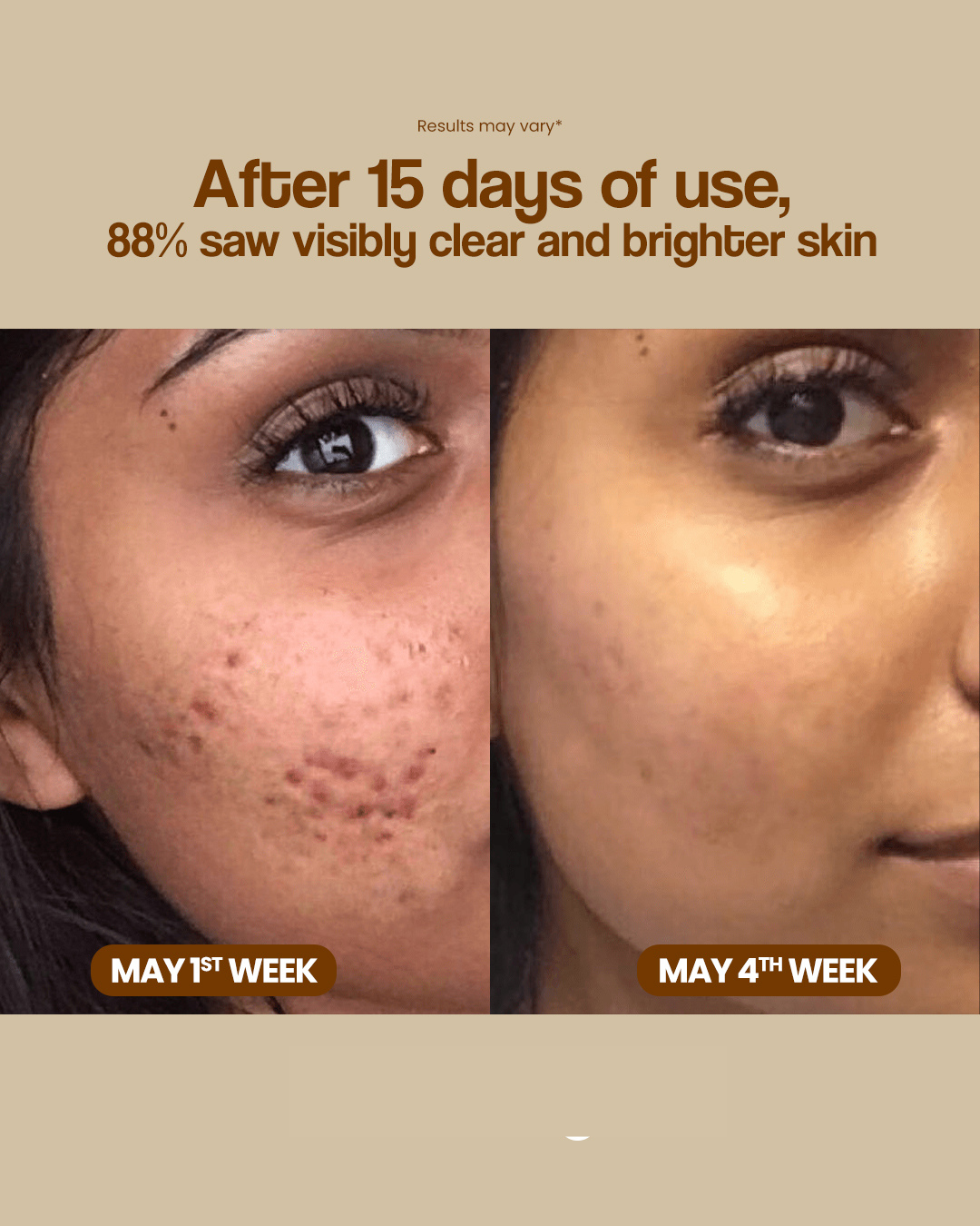 Anti Acne and Brightening Serum - Arbutin + GlowReset - SkinSync-AcneComplex - Dark Spot Corrector - 30 ML