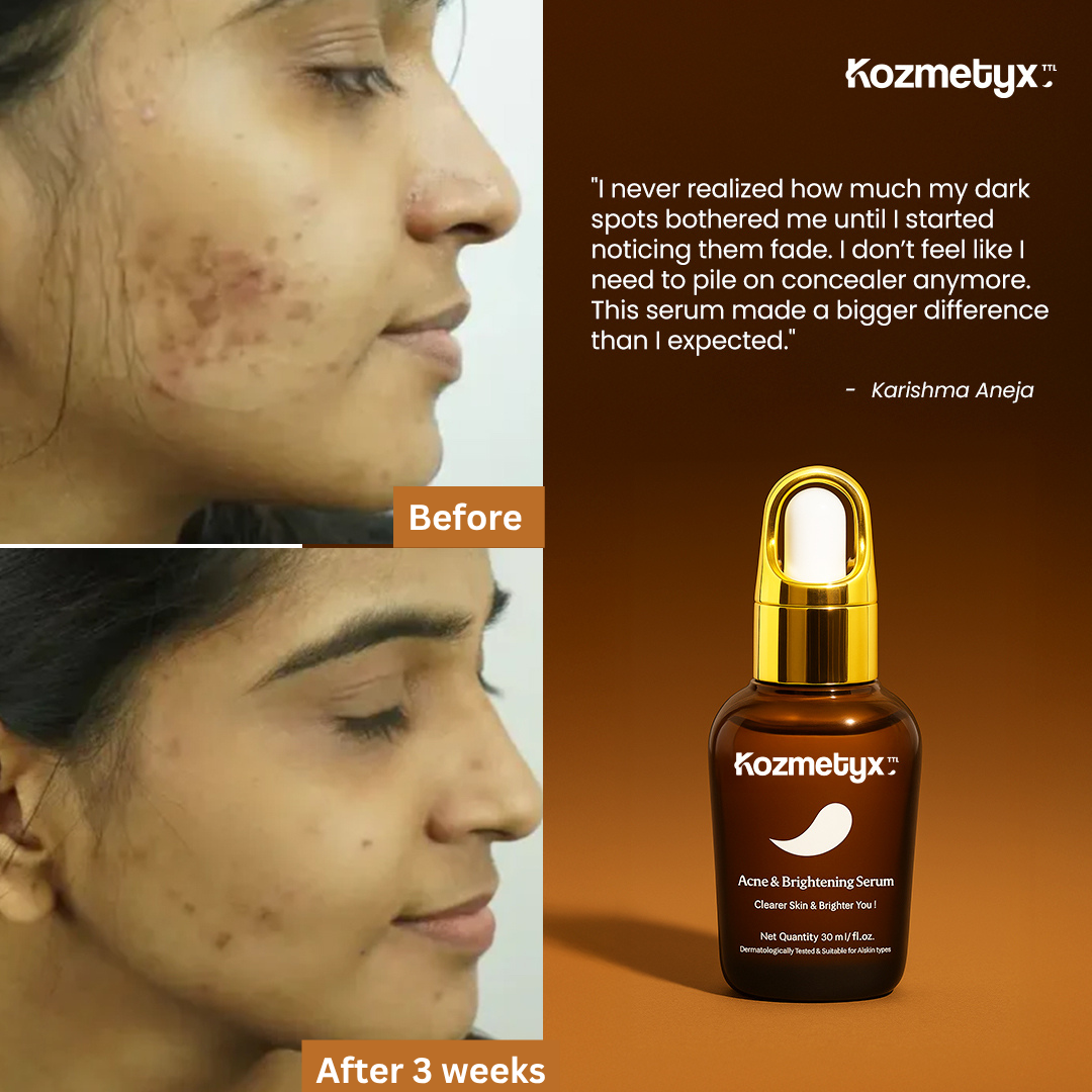 Anti Acne and Brightening Serum - Arbutin + GlowReset - SkinSync-AcneComplex - Dark Spot Corrector - 30 ML