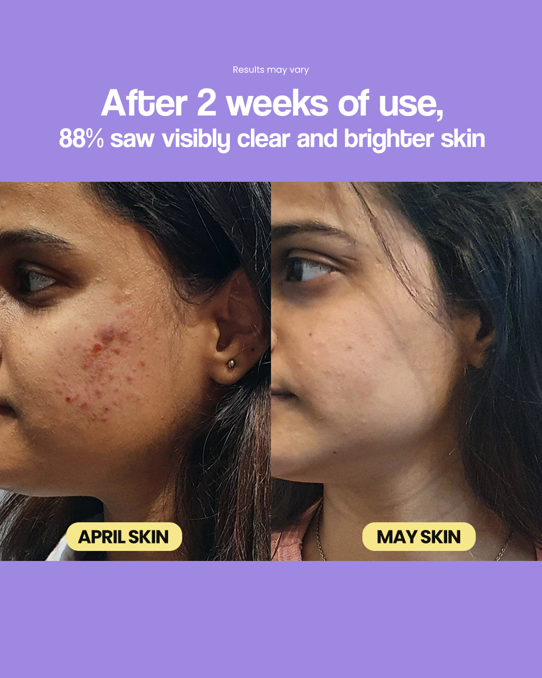 Anti Acne and Brightening Serum - Arbutin + GlowReset - SkinSync-AcneComplex - Dark Spot Corrector - 30 ML