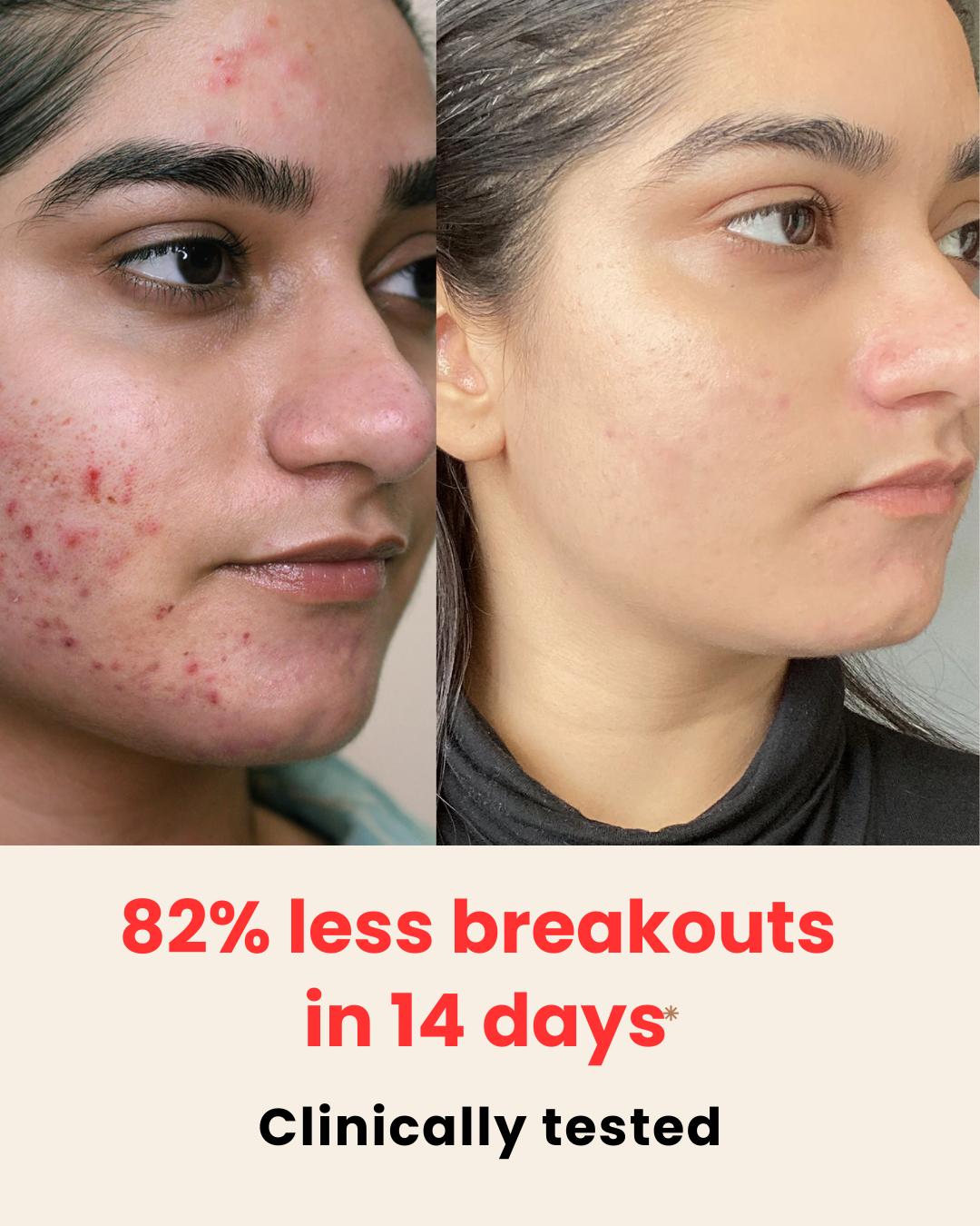 Anti Acne and Brightening Serum - Arbutin + GlowReset - SkinSync-AcneComplex - Dark Spot Corrector - 30 ML