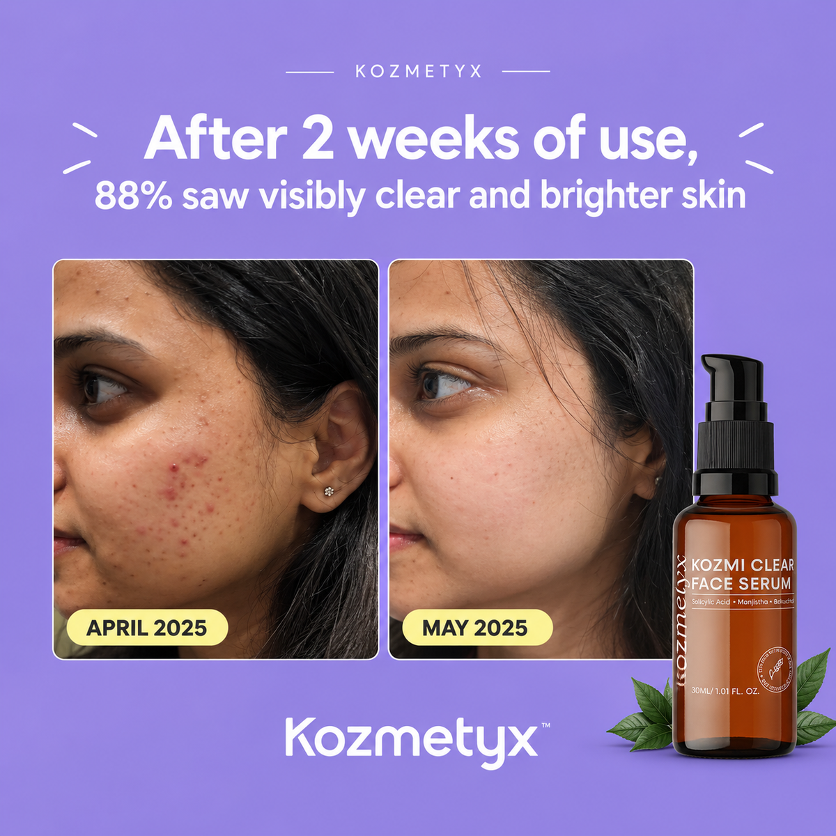 Kozmi Clear Anti-Acne &amp; Brightening Face Serum