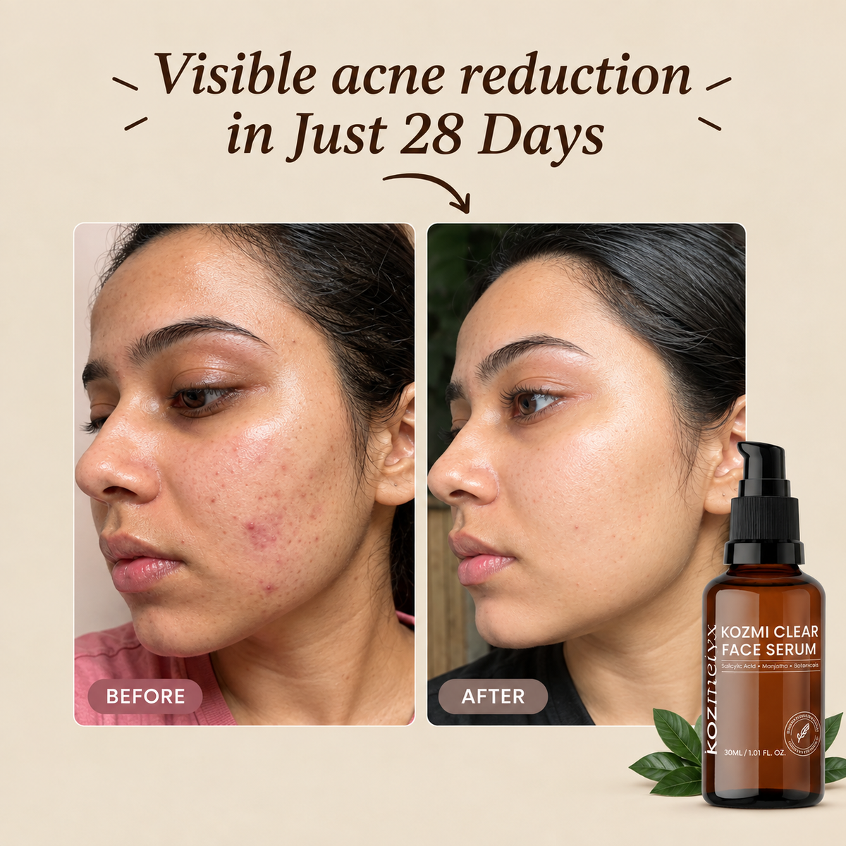 Kozmi Clear Anti-Acne &amp; Brightening Face Serum
